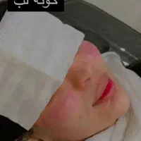 مدل فیلر صورت وگونه و بلدینگ ابرو