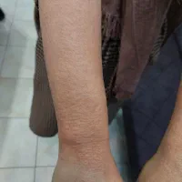 لیزر کندلا با قیمت دوسال پیش