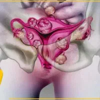 خداحافظی با مشکلات بانوان (کیست و فیبروم)