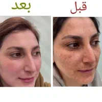 جشنواره درمان تضمینی کک و مک/ زگیل / فقط در 1 جلسه
