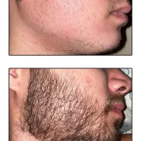 درمان صددرصد گیاهیه و رویش مجدد