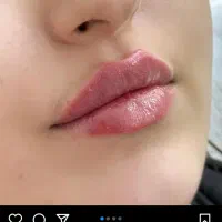 خدمات تخصصی ژل وبوتاکس و پی ارپی ولاغری ورفع غبغب