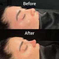 عمل بینی با کمترین عارضه و تجهیزات به روز