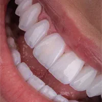 دندانپزشکی/ایمپلنت دندان/لمینیت/اقساطی