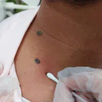 خالبرداری و برداشتن زائده پوستی در پادادشهر