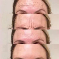 وقتشه با بوتاکس جوان‌تر به نظر برسی