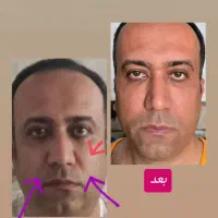 لیفت با نخ|خدمات آرایشگری و زیبایی|اصفهان, باغ زیار|دیوار