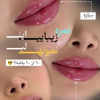 بوتاکس پیشانی،خط اخم رایگان شد توسط پزشک|خدمات آرایشگری و زیبایی|کاشان, بهشتی|دیوار