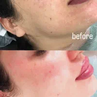 تزریق فیلرلب،ژل،شیدینگ،هایفوبدون پیشکاملااقساط|خدمات آرایشگری و زیبایی|اردبیل, |دیوار