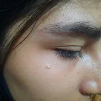 حذف خال ،زگیل فقط با قطره