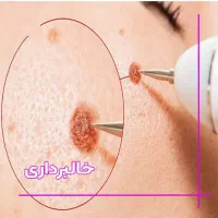 خدمات میکرونیدلینگ و خالبرداری با تخفیف مدت محدود