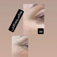 تزریق ژل با قیمت مناسب وبا کیفیت|خدمات آرایشگری و زیبایی|برازجان, |دیوار