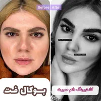 جشنوار بلفاروپلاستی-غبغب-بوکال فت-سانترال لب|خدمات آرایشگری و زیبایی|تهران, پاسداران|دیوار