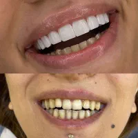 مدل جهت کامپوزیت دندان