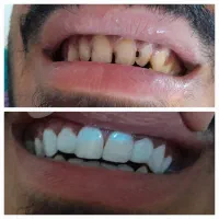 کامپوزیت دندان. پرکردن. ترمیم پوسیدگی.