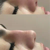 تزریق ژل و بوتاکس  تخفیف ویژه تا اخر هفته جدید|خدمات آرایشگری و زیبایی|گنبد کاووس, |دیوار