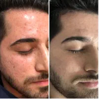 پاکسازی و روشنسازی و جوانسازی پوست|خدمات آرایشگری و زیبایی|مشهد, شهید فرامرز عباسی|دیوار