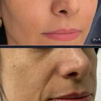 چروکهاتو اتو کن با جوانساز حرفه ای