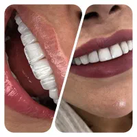 کامپوزیت دندان/دندانپزشکی (اقساطی)