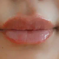 تزریق ژل و بوتاکس