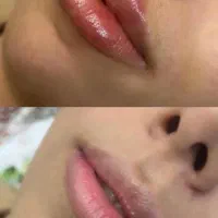 تزریق فیلر و بوتاکس|خدمات آرایشگری و زیبایی|قرچک, مهدیه|دیوار