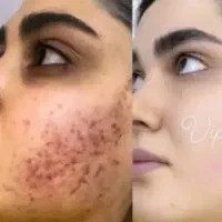 نحوه ساخت کرم همه کاره ضدلک روشن کننده ضدجوش وو