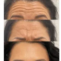 لیزر، بوتاکس، فیلر، جوانسازی