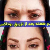 تزریق ژل و بوتاکس و فیلر بادی باتخفیف توسط پزشک|خدمات آرایشگری و زیبایی|شیراز, کلاهدوز|دیوار