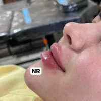 ژل و فیلر و بوتاکس|خدمات آرایشگری و زیبایی|مشهد, ده دی|دیوار