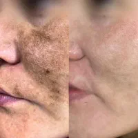 درمان تخصصی لک و کک و مک