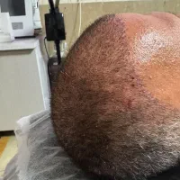 مزوتراپی مو (قطع ریزش)|خدمات آرایشگری و زیبایی|اندیشه, اندیشه فاز ۳|دیوار