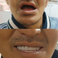 دندانسازی پیرهادی بامتد جدید کنترل لقی دندان