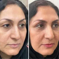 جشنواره تخفیفات بلفاروپلاستی
