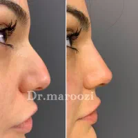 تزریق ژل لب بوتاکس لیفت ابرو کانتورینگ و آموزش|خدمات آرایشگری و زیبایی|تهران, پونک|دیوار