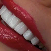 کامپوزیت دندان.لمینت دندانپزشکی. ایمپلنت.عصب کشی|خدمات آرایشگری و زیبایی|تهران, تهرانپارس جنوبی|دیوار