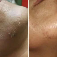 فیشیال و پاکسازی پوست بانوان|خدمات آرایشگری و زیبایی|کرمانشاه, |دیوار