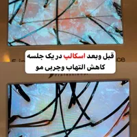 پاکسازی کف سر و اسکراب اسکالپ ۴۰۰