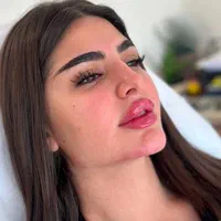 تزریق ژل و بوتاکس لیفت نخ جدیدترین متد مطب زیبایی|خدمات آرایشگری و زیبایی|کرج, گوهردشت|دیوار