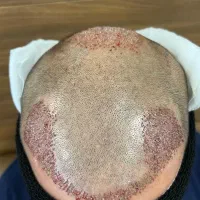 کاشت مو تضمینی با روش fit