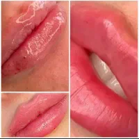 مرکز تخصصی جراحی زیبایی زنان،ژل،بوتاکس