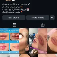 مدل فیلر کل صورت ،ژل لب، چونه،گونه،زاویه فک|خدمات آرایشگری و زیبایی|مشهد, هنرستان|دیوار