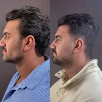 تزریق چربی بوکال فت کاشت مو ساکشن غبغب بلفاروپلاسی|خدمات آرایشگری و زیبایی|اصفهان, ملک‌شهر|دیوار