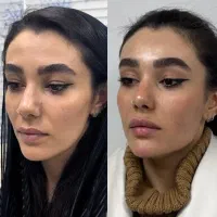ژل بوتاکس فیلر فیشیال مزوتراپی توسط پزشک مجرب|خدمات آرایشگری و زیبایی|شهریار, شهریار|دیوار