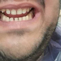 ساخت انواع دندان متحرک و ثابت|خدمات آرایشگری و زیبایی|اهواز, پادادشهر|دیوار