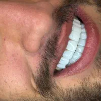 سورپرایز ارزانترین قیمت کامپوزیت دندان