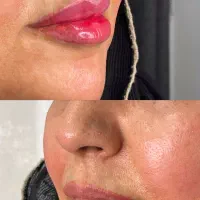 نیازمندمدل تزریق فیلر چانه،لب،زاویه، گونه کات|خدمات آرایشگری و زیبایی|تهران, صد دستگاه|دیوار
