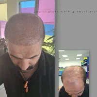 کاشت مو و ابرو|خدمات آرایشگری و زیبایی|میانه, |دیوار