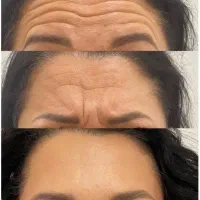 بوتاکس کامل صورت خارجی فقط 750تخفیف دار