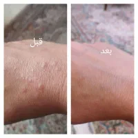 ترک پا،میخچه، اگزما|آرایشی، بهداشتی، درمانی|قروه, |دیوار