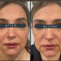 مرکز تخصصی هایفو پاک کردن تتوابرو بالیزر توسط پزشک